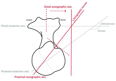 humeral torsion studies